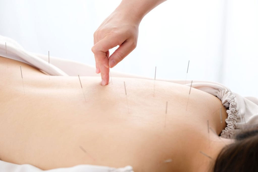 Mesolippo Acupuncture